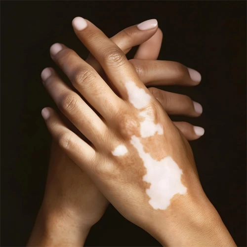 Vitiligo